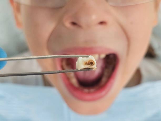 Best Emergency Tooth Extraction in Madisonville, TN