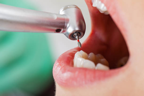 Best Emergency Root Canal Treatment in Madisonville, TN